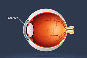 cataract diagram - forbes opticians, hadleigh, essex